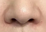 鼻翼矫正术后运动指南：科学规划恢复期，安全重拾活力-56157