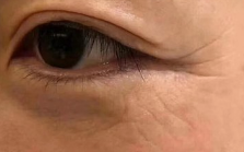 探店实测：玻尿酸“大小分子”的秘密，藏在专业机构的细节里