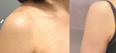 吸脂术后皮肤松弛问题解析：年龄与吸脂量是关键因素