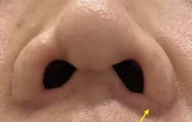 鼻翼矫正避坑指南：朝天鼻修复如何避开“无效手术”陷阱-56195