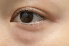 美国眼袋手术费用大揭秘：5000-15000美元背后的“贵”因何在？