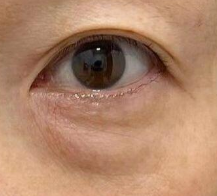 眼袋手术后出血怎么办？3招教你科学应对，避免“血色危机”！