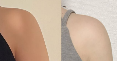 吸脂后不满意还能再做一次吗？看看她的二次吸脂经历你就懂了